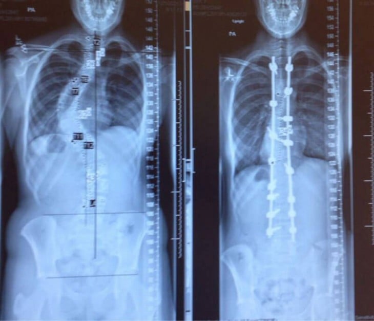 Fotografías viendo el mundo desde otro ángulo (Radiografías de una columna vertebral) 